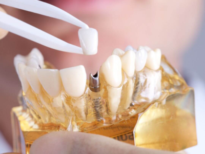Implants Without Bone Graft