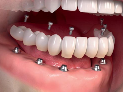 Permanent Teeth