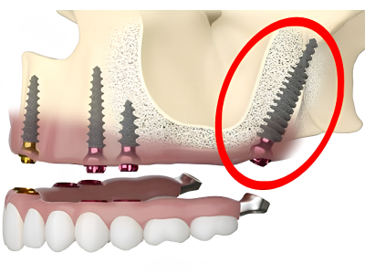Pterygoid Implants