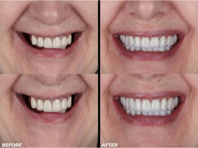 Smile Makeover