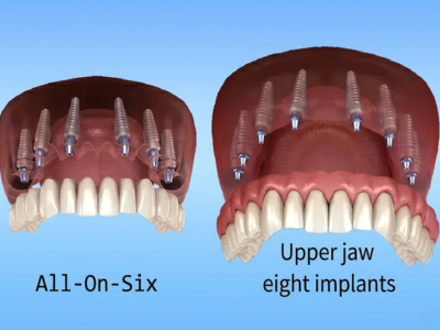Upper Jaw Full Arch