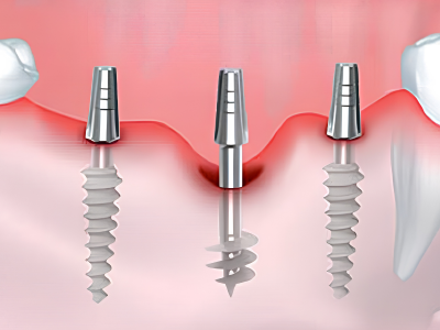 Basal Implants