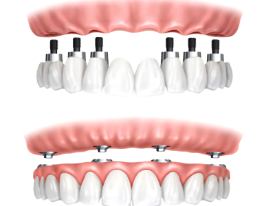 Full Mouth Dental Implants