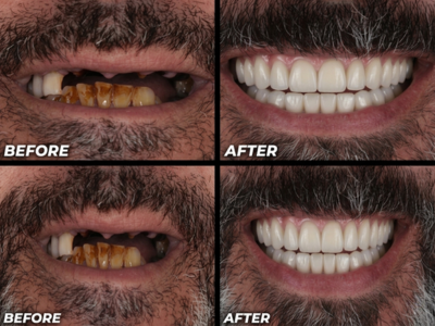 Full Mouth Reconstruction