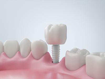 Zirconia Crowns